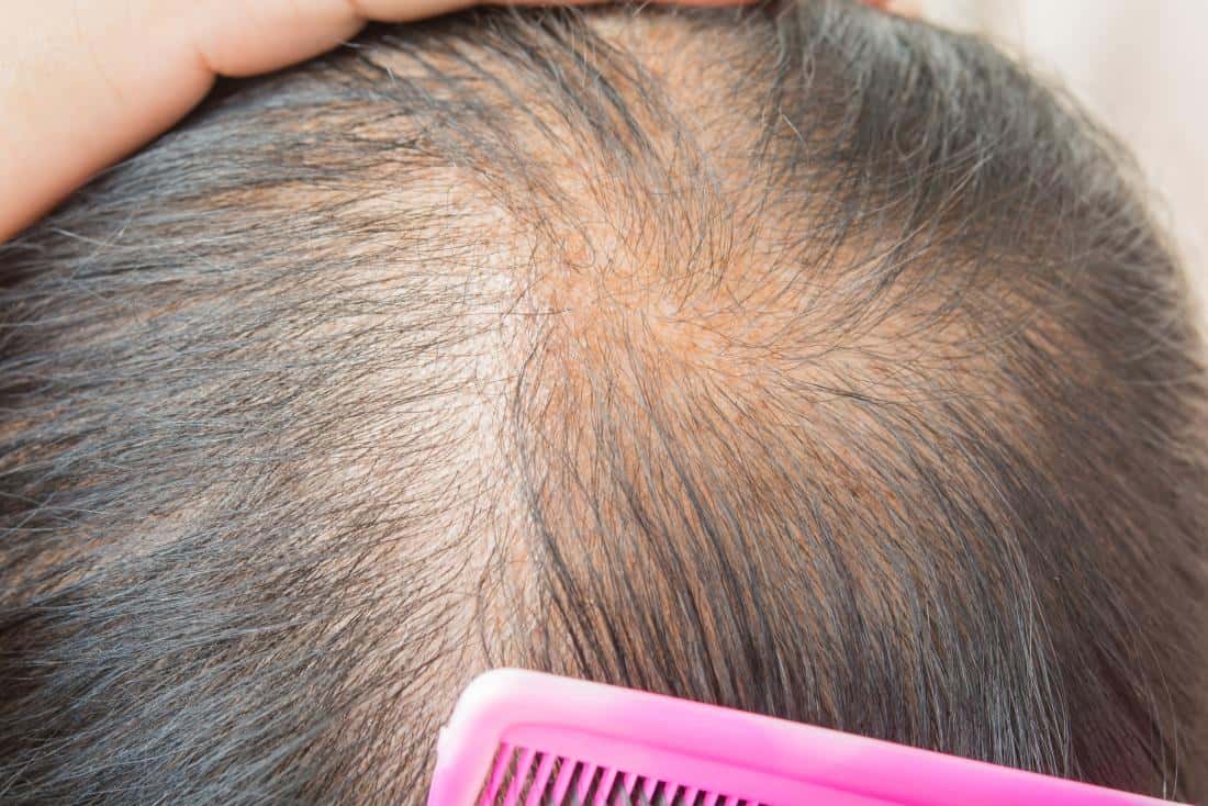 izpadanje-las-dermatoloska-oskrba